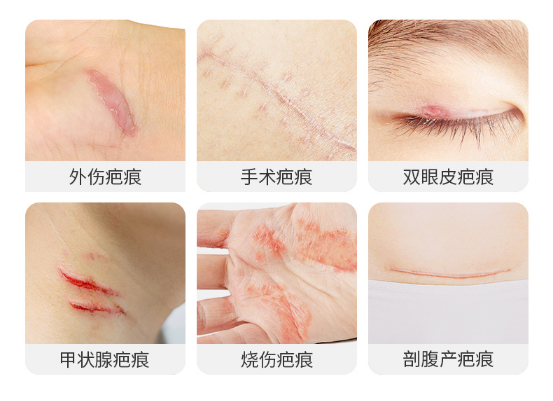 二医院皮肤科：夏季疤痕护理的注意事项
